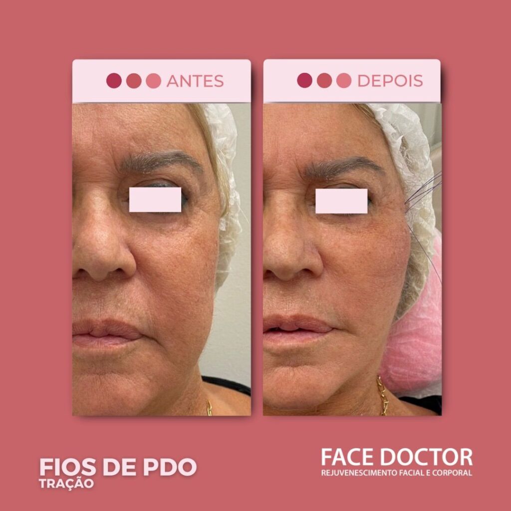 Fios ed PDO