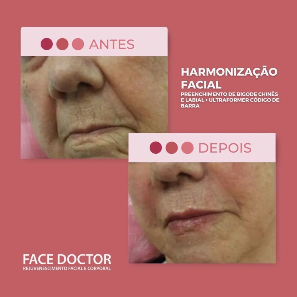 Harminização facial 2