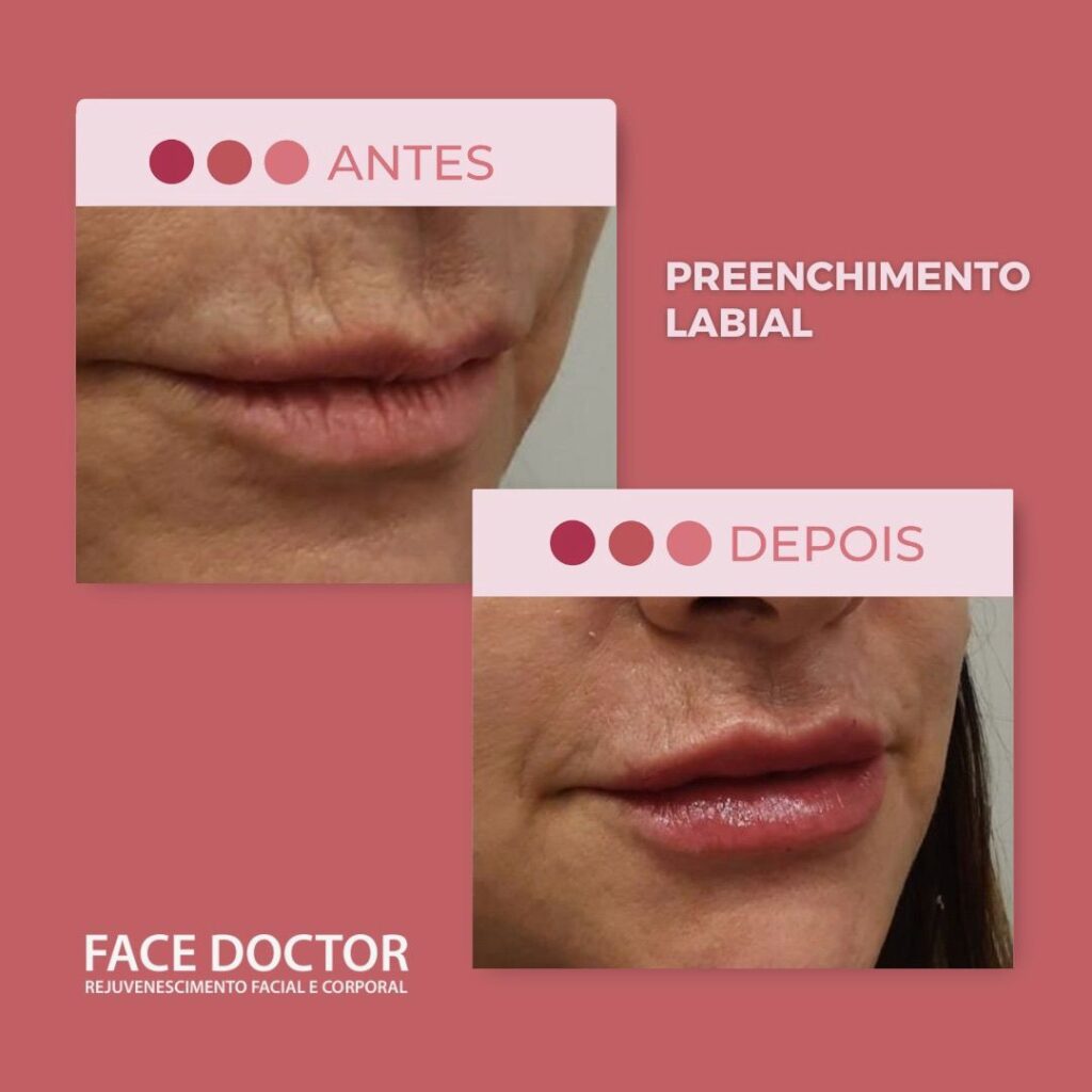 Preenchimento Labial