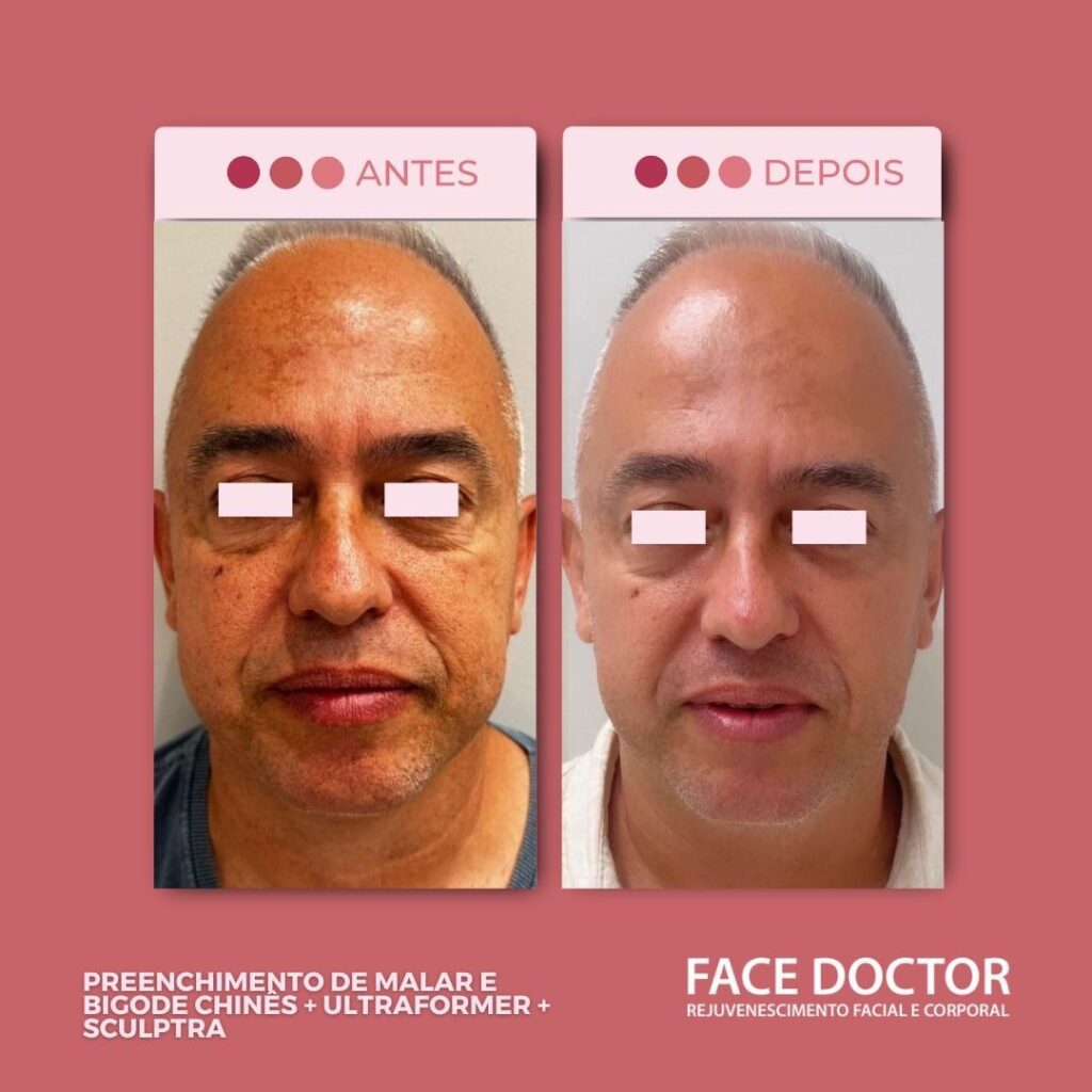 Preenchimeto de malar e Bigode Chines