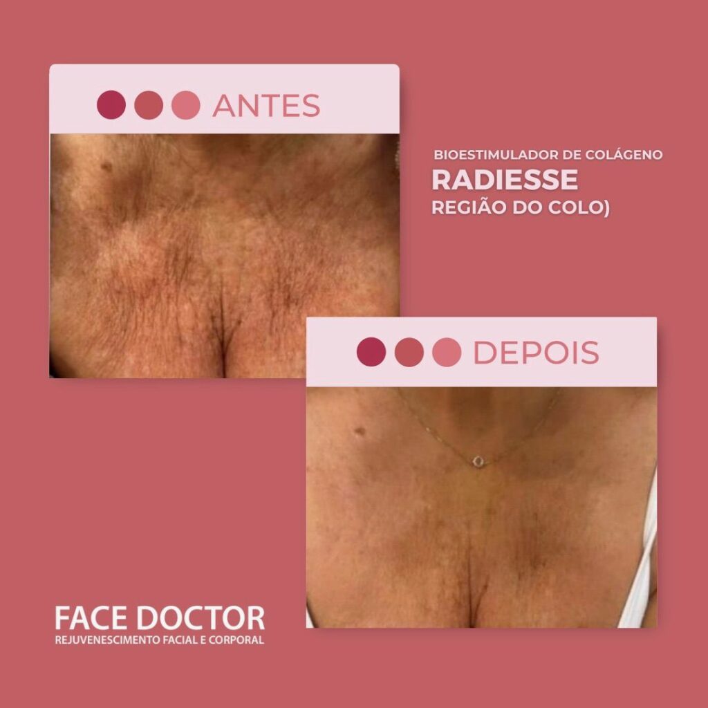 Radiesse