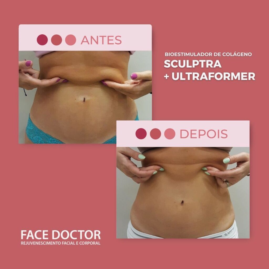 Sculptra + Ultraformer