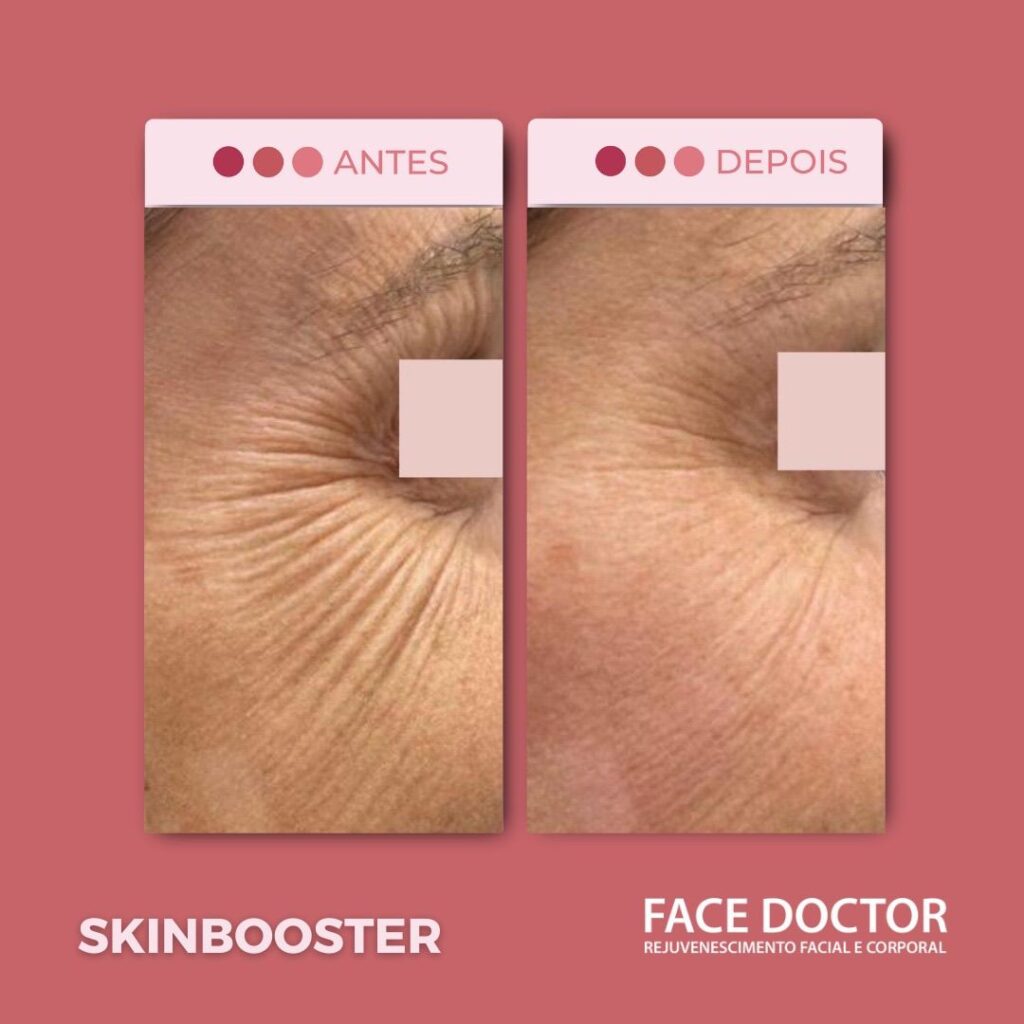 SkinBooster