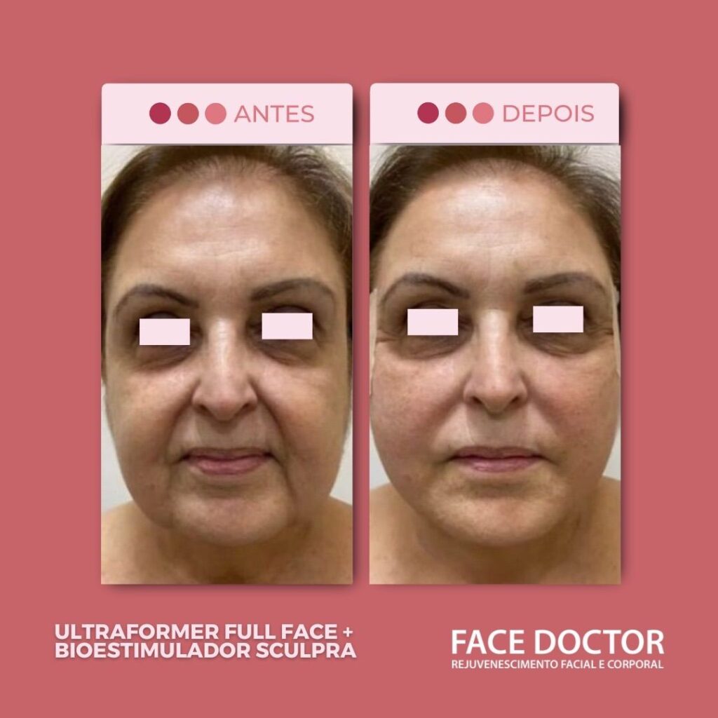 UF Full Face 3