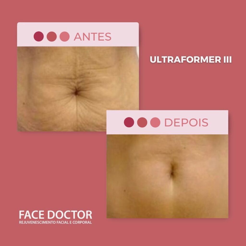 UF III