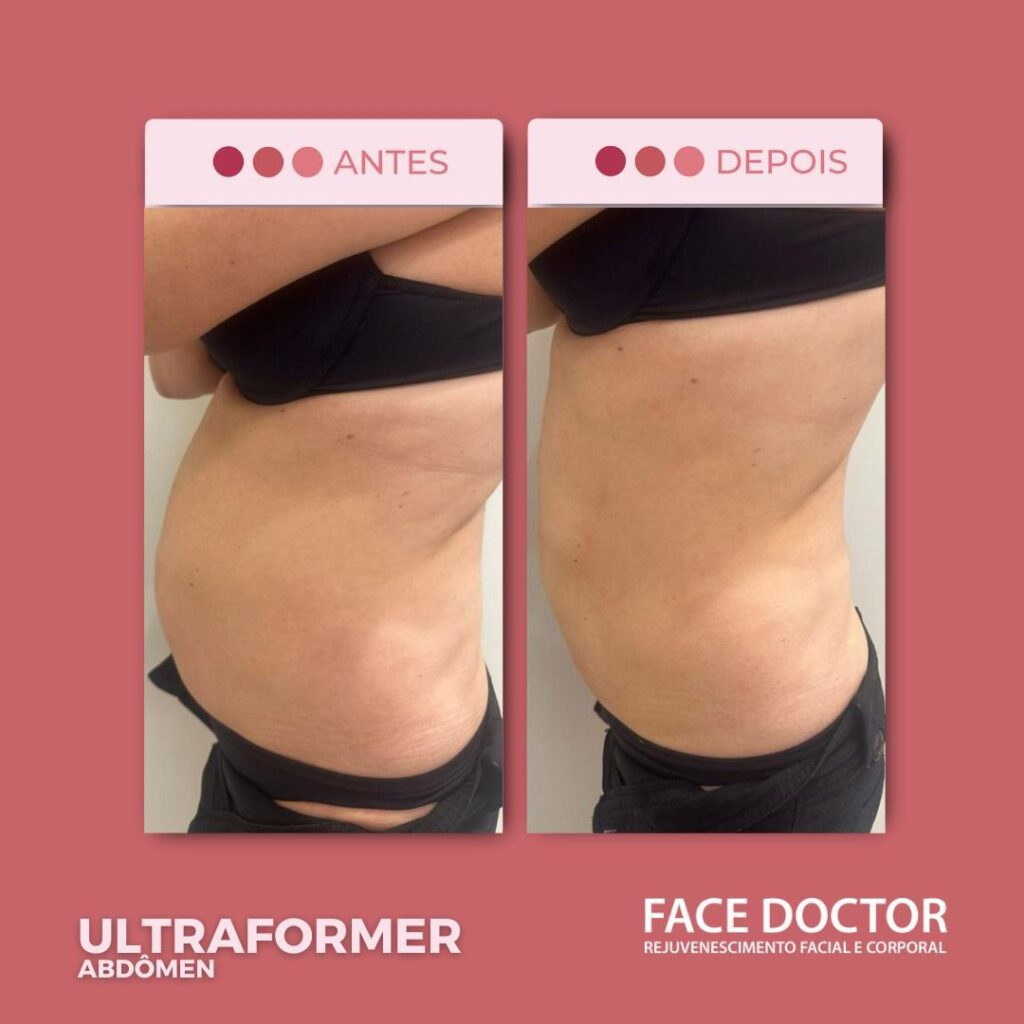 Ultraformer Abdomen